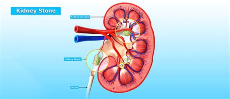 Kidney Stone (Nephrolithiasis) Symptoms and Causes