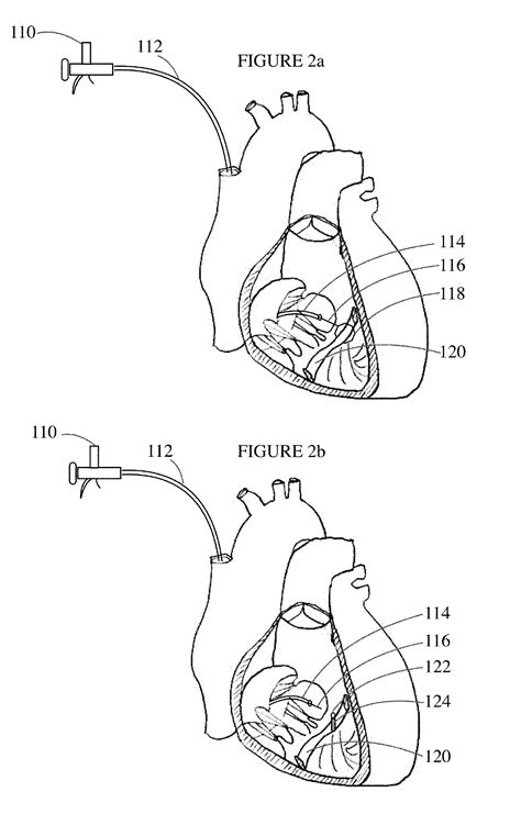 Septomarginal trabecula attachment for heart valve repair - Eureka | Patsnap develop ...