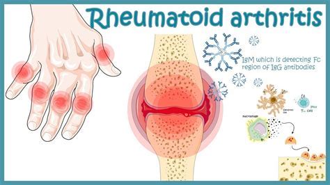 Understanding Autoimmune Arthritis: Types, Symptoms, and Comprehensive Guide - Becker Spine