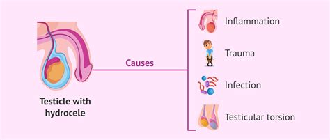 Causes of testicular hydrocele