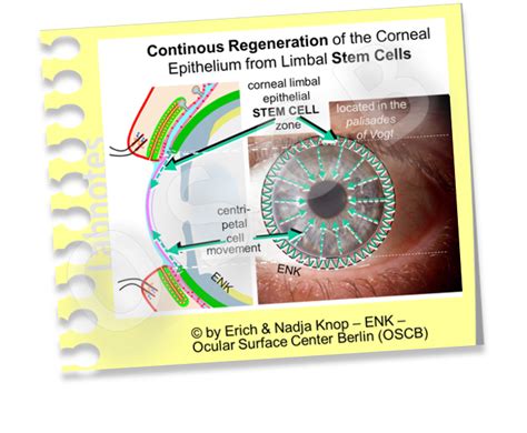 The CORNEA — Ocular Surface Center Berlin