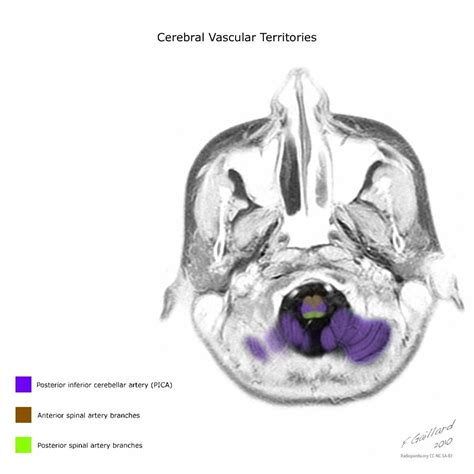 Cerebral vascular territories | Radiology Case | Radiopaedia.org Gross Anatomy, Brain Anatomy ...