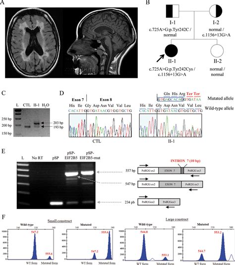 Clinical and genetic features. (A) Periventricular T2 white matter ...