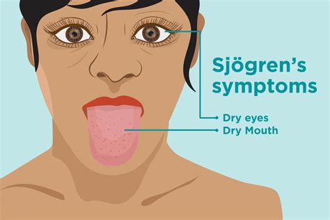 Sjögren Syndrome - Functional Medical Corporation