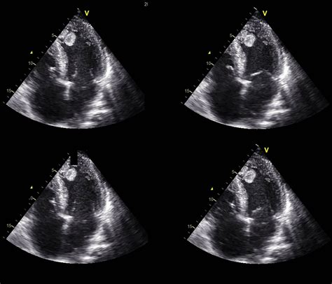 Left ventricular thrombus formation after acute myocardial infarction | Heart