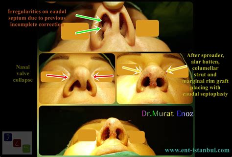 We Performed Revision Open Technique Caudal Septoplasty + Nasal Valve Surgery