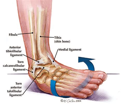 Do you ice your ankle after an ankle sprain? There's more to it!