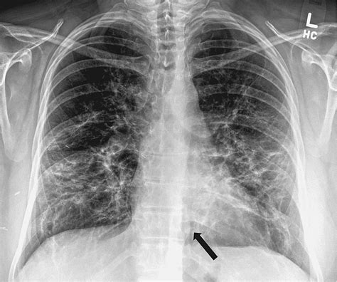 A Unique Presentation of Spontaneous Pneumomediastinum Following COVID-19 Infection | Cureus