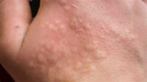 Stinging Nettle Rash: Pictures, Treatment, Home Remedy