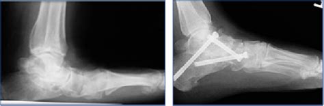 A Guide To The Triple Arthrodesis For Hindfoot Deformities