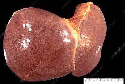 Congestive hepatopathy - Stock Image - C049/9150 - Science Photo Library