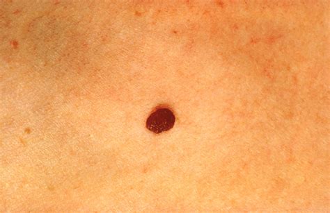 Medical Pictures Info – Cancer Mole