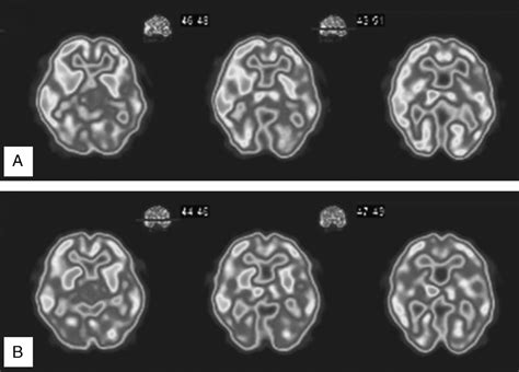 Two Cases of Oral Somatic Delusions Ameliorated With Brain P... : Clinical Neuropharmacology