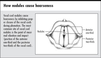 Symptoms and Causes - Vocal Nodules