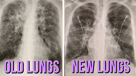 Lung Transplant Cystic Fibrosis