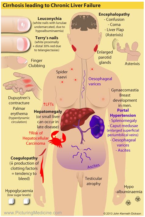 Liver Disease & Diet for Health