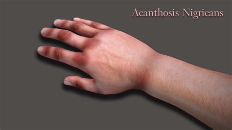 Acanthosis Nigricans - Dr. Walia's Skin And Laser Clinic