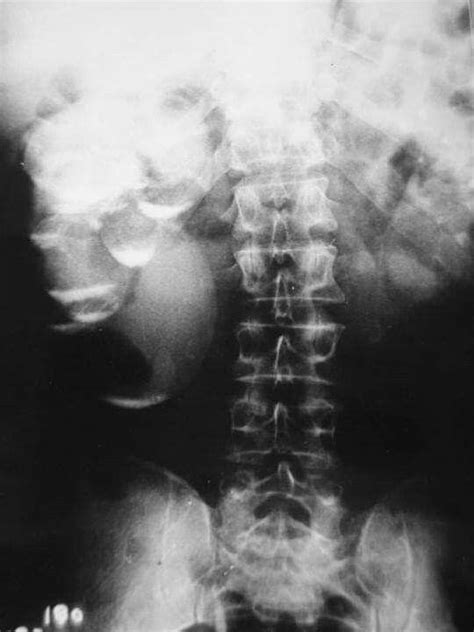 FINAL DIAGNOSIS Renal milk of calcium cyst. | Renal, Cysts, Radiology