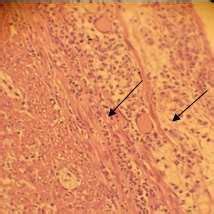 Photomicrograph of T. S. of appendix showing appendicitis with... | Download Scientific Diagram