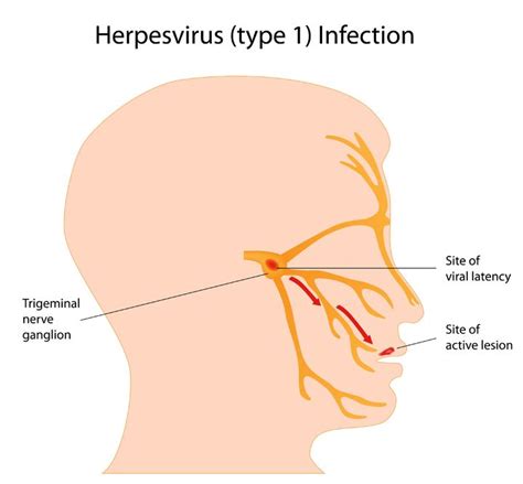 Herpes Simplex Virus: HSV-1 and HSV-2 | NPC