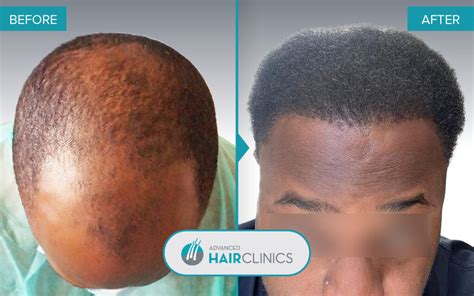 FUE Hair Transplant Before And After Results | Advanced Hair Clinics