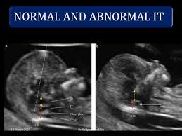 Abnormal Nuchal Translucency Normal Baby - expeditionwoman