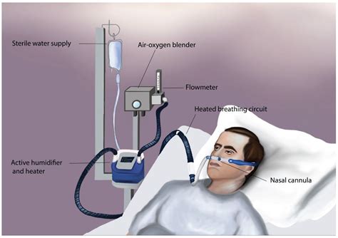 JCM | Free Full-Text | High-Flow Oxygen Therapy in the Perioperative ...