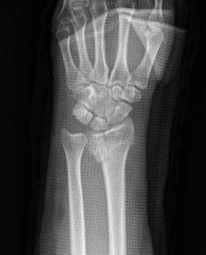 Distal radius fracture non-operative treatment - wikidoc