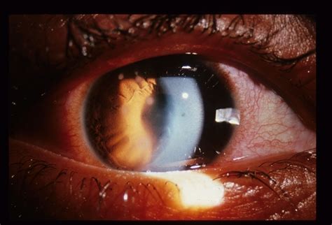 Acanthamoeba Keratitis - Retina Image Bank