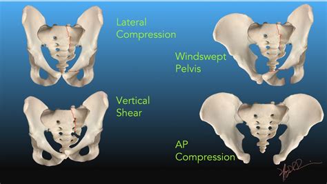 Pelvic Fractures | UW Emergency Radiology