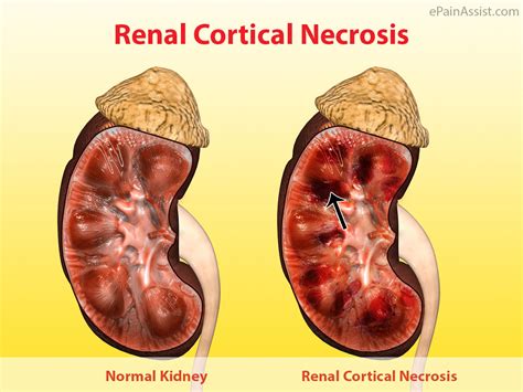 Renal Cortical Necrosis (RCN)|Types | Causes | Risk Factors | Symptoms | Diagnosis | Treatment