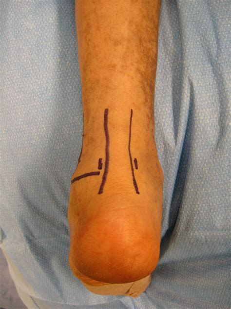 Subtalar Arthroscopy (Foot Arthroscopy) | Dr Carreira | Atlanta, GA