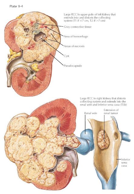 RENAL CELL CARCINOMA - pediagenosis