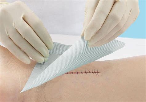 Incision Care and the Prevention of Surgical Site Infections - Medline