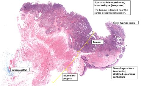 Vanishing Twin Histology