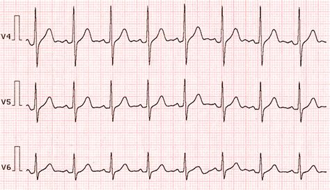 Ventricular Tachycardia: Causes, Symptoms and Treatment