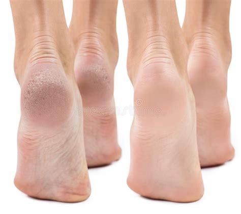 Feet with Dry Skin before and after Treatment. Stock Photo - Image of person, perfect: 113028882