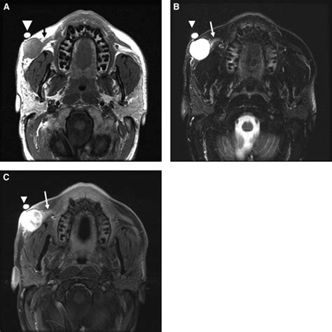 MRI sign of nodular fasciitis: a case report - Oral Surgery, Oral ...