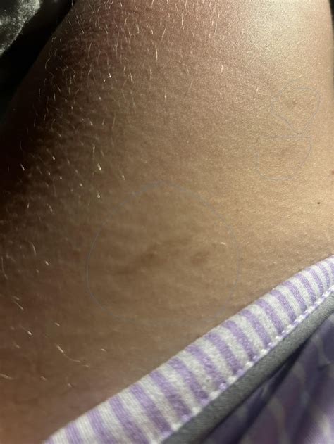 Brown spots on inner thigh showed up : r/DermatologyQuestions