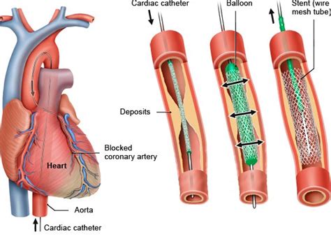 What happens during cardiac catheterization? | informedhealth.org