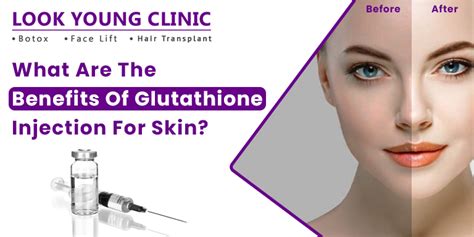 What Are The Benefits Of Glutathione Injection For Skin?