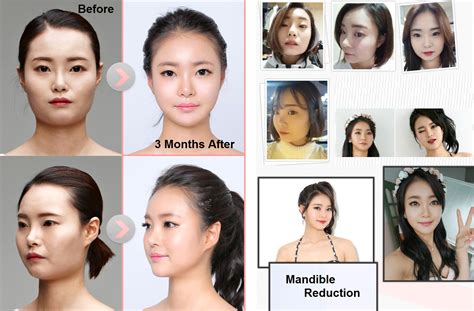 Plastic Surgery Before and after Archives - Seoul Guide Medical