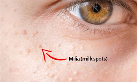 Milia on Face: How to Get Rid of Milia on Face at Home Easily