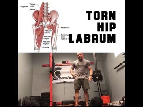 Torn Hip Labrum? DO THIS NOW! | SmashweRx | Trevor Bachmeyer - YouTube | Strengthen hips, Best ...