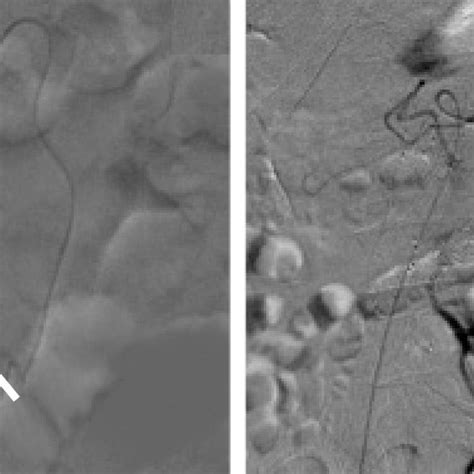 (PDF) Peripheral use of detachable coils: Expanding the boundaries of embolization