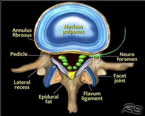 The Radiology Assistant : Lumbar Disc Herniation (2023)