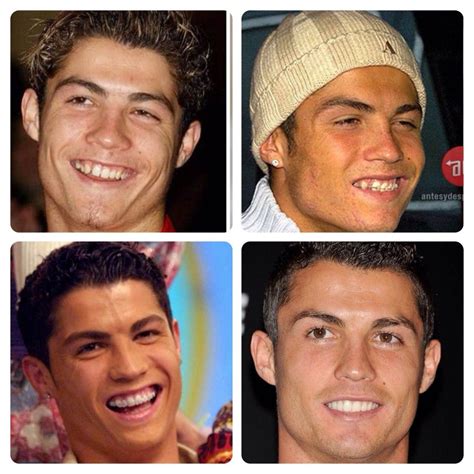 Cristiano Ronaldo Smile Transformation