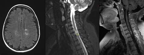 Research | Multiple Sclerosis Center