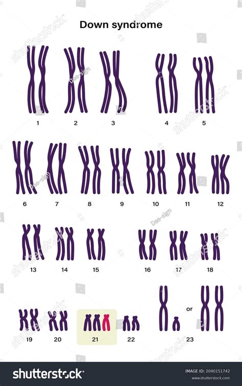 Human Karyotype Down Syndrome Autosomal Abnormalities Stock Vector ...