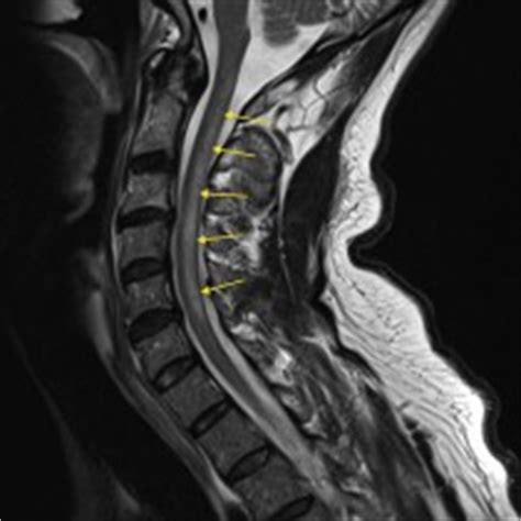 Syrinx – MRI - Radiology at St. Vincent's University Hospital